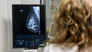 La IA detecta un 30% més de càncers de mama i tumors més avançats