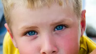 El síndrome del niño abofeteado: cómo se contagia y por qué es importante que estos menores no estén cerca de mujeres embarazadas