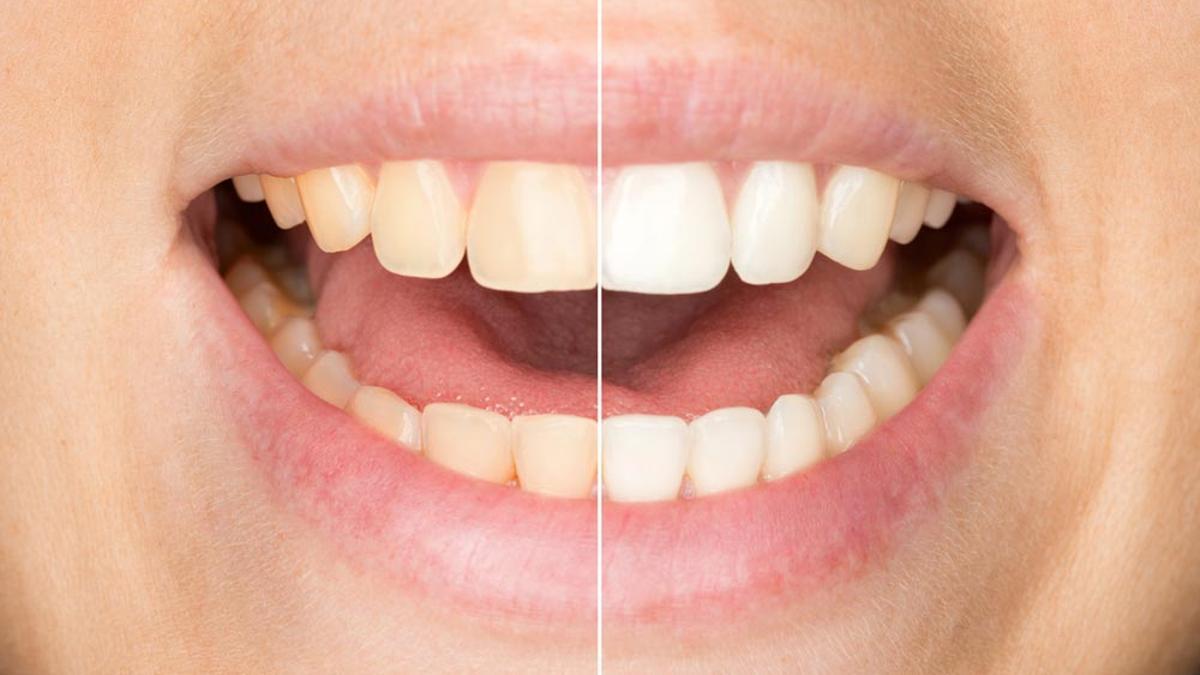 Cúrcuma, tu aliada para conseguir unos dientes más blancos