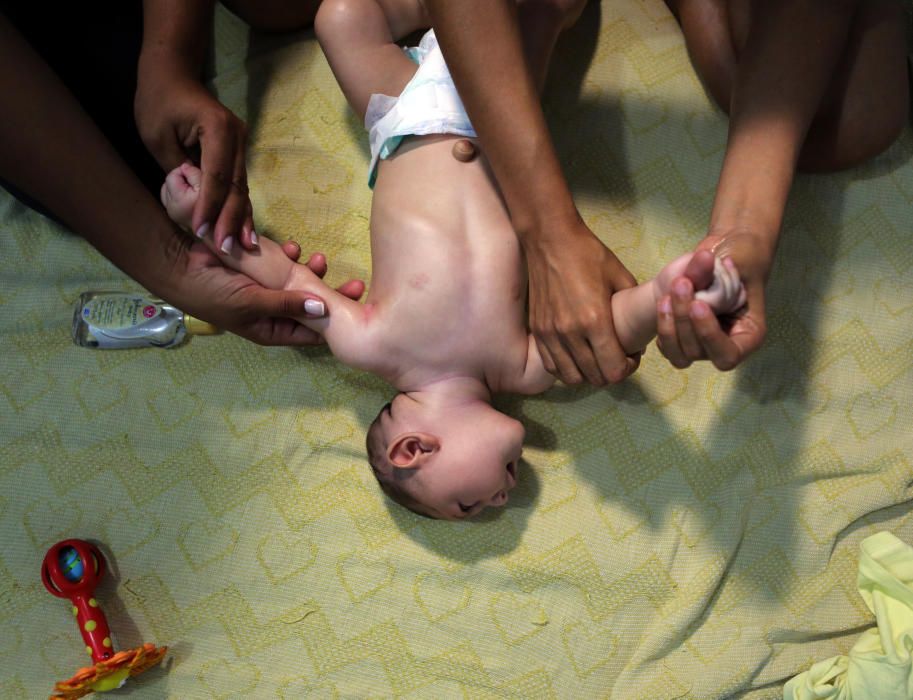 Un terapeuta enseña al padre de Juan Pedro, bebé enfermo de microcefalia por culpa del virus zika, a dar masajes al niño para aliviar sus síntomas en Recife, Brasil.