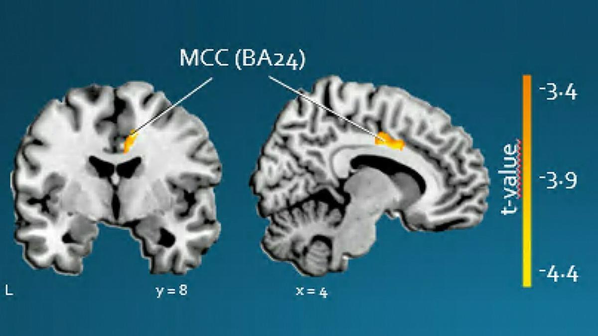 Identifican la afectación de una región cerebral que predice la evolución de la apatía en los pacientes de Huntington.