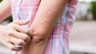 Picaduras de mosquitos: el sencillo truco casero para acabar con ellas