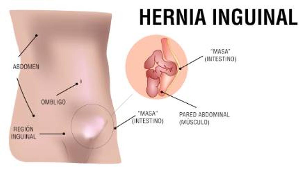 Una hernia inguinal es una condición médica en la que una parte del contenido abdominal, como el intestino, protruye a través de un punto débil en la pared abdominal