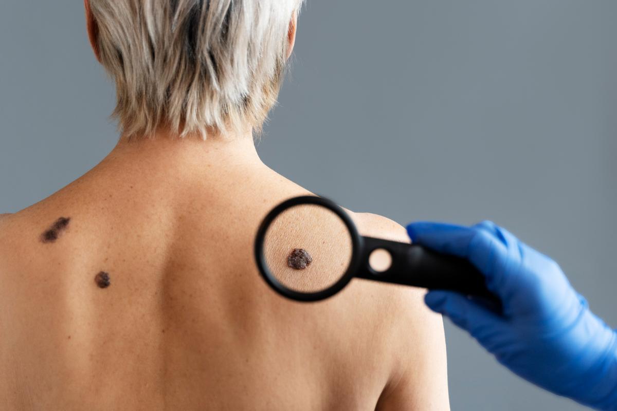 Un experto examina un lunar irregular en la espalda de una paciente.