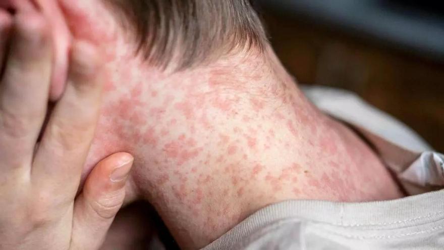 Masern-Ausbruch auf Mallorca: Sechs Fälle bestätigt – Gesundheitsbehörde rechnet mit weiteren Infektionen