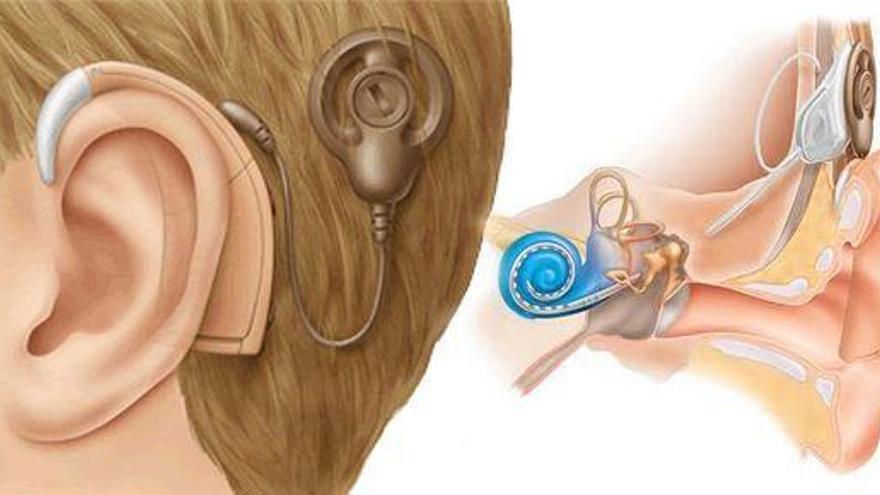 Más de 300 murcianos recuperan la audición gracias a la Arrixaca