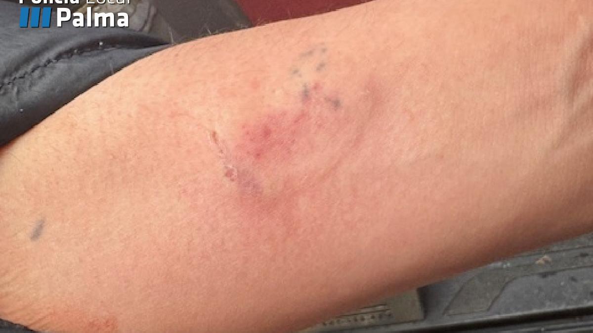 Señales del mordisco en el antebrazo del hombre.