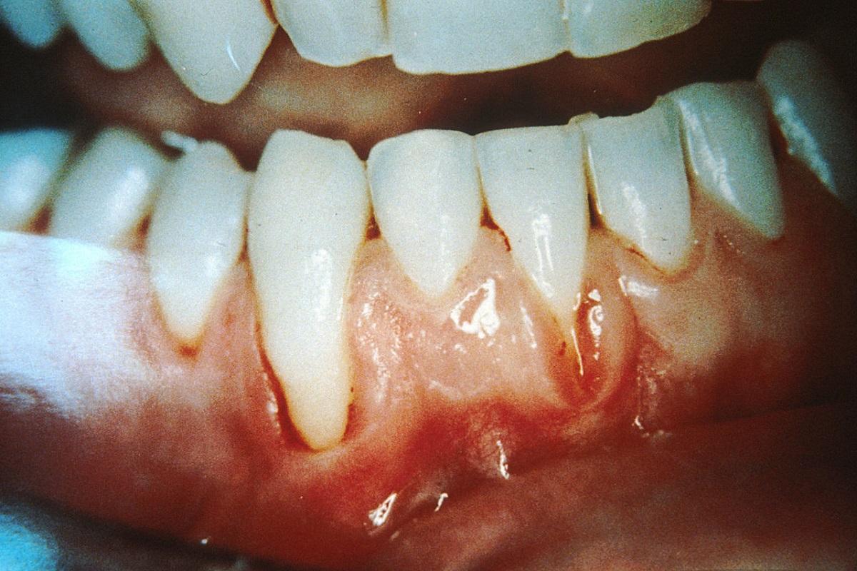 Esta enfermedad de las encías puede provocar la pérdida del diente.