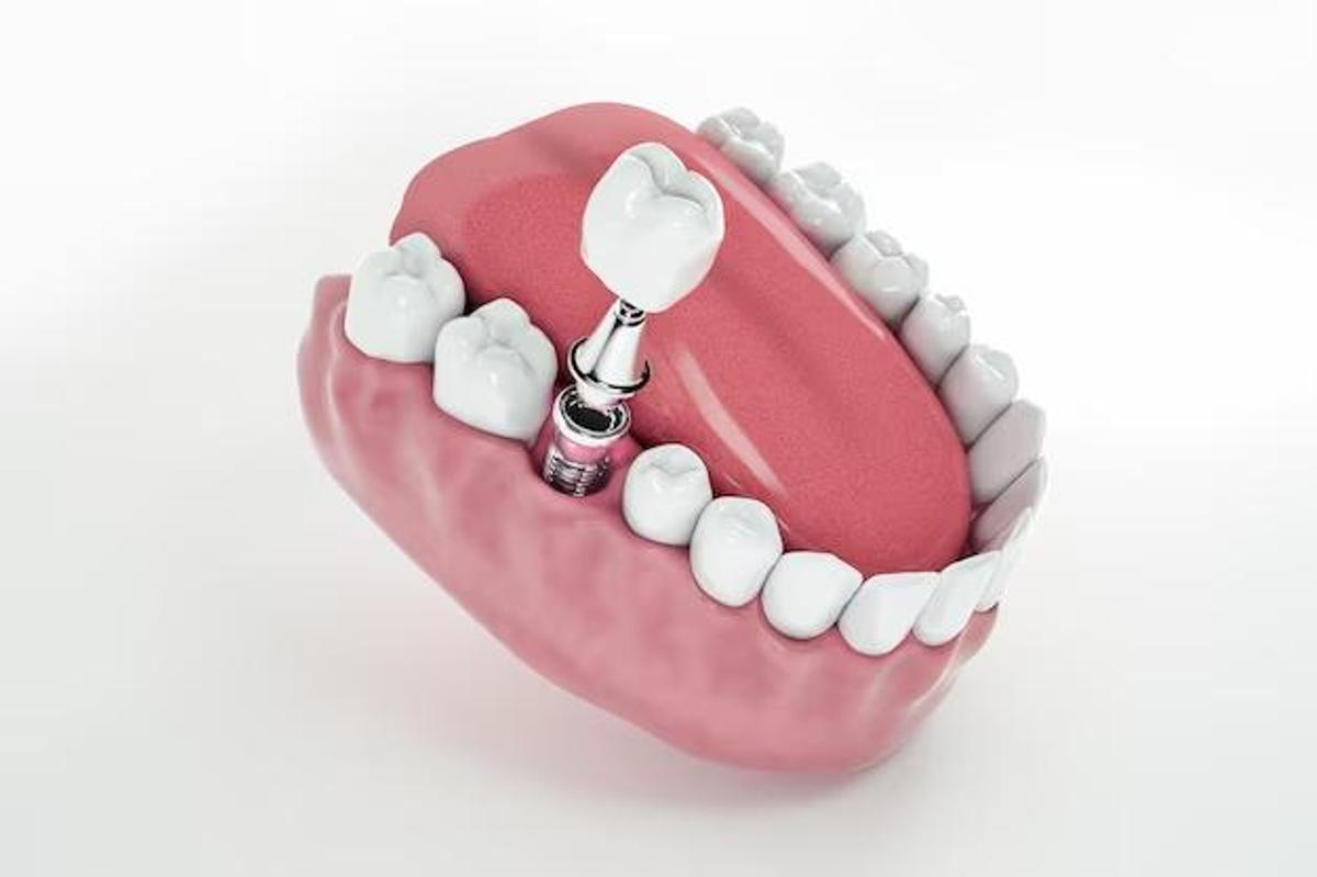 Los pacientes pueden recuperar sus piezas dentales en una sola sesión