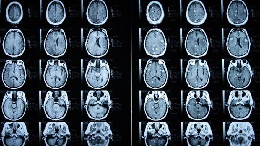 Una imagen de una tomografía cerebral.
