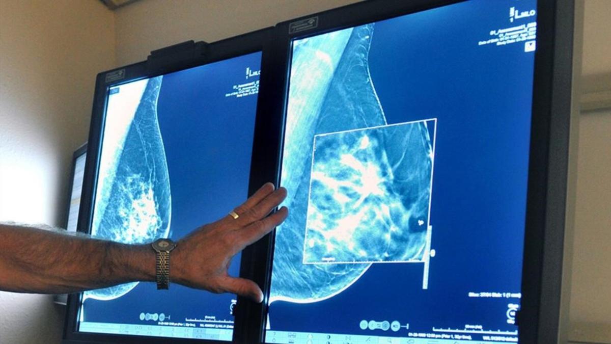 Consejos para prevenir el cáncer de mama