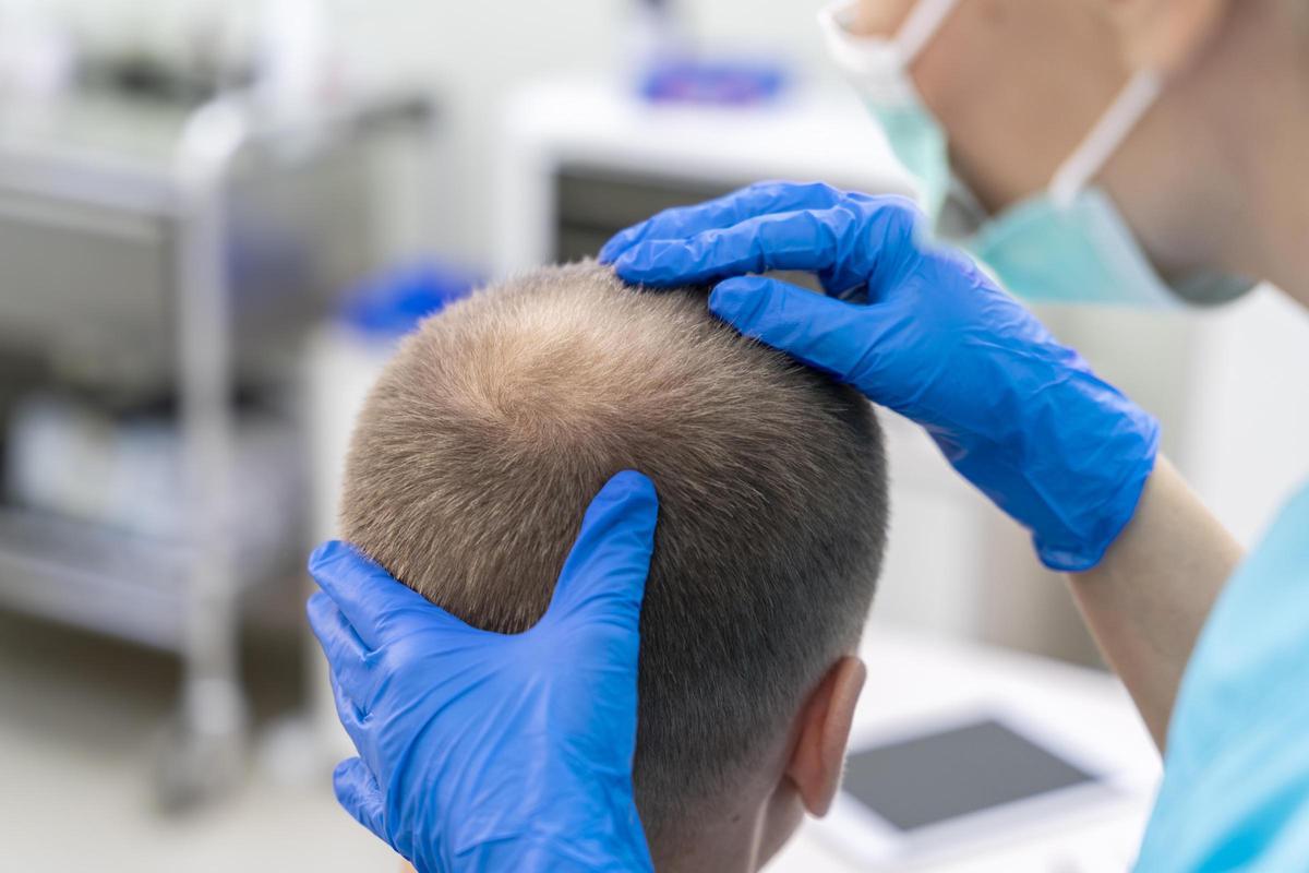 El injerto capilar sin rapar es una técnica avanzada de trasplante de cabello.