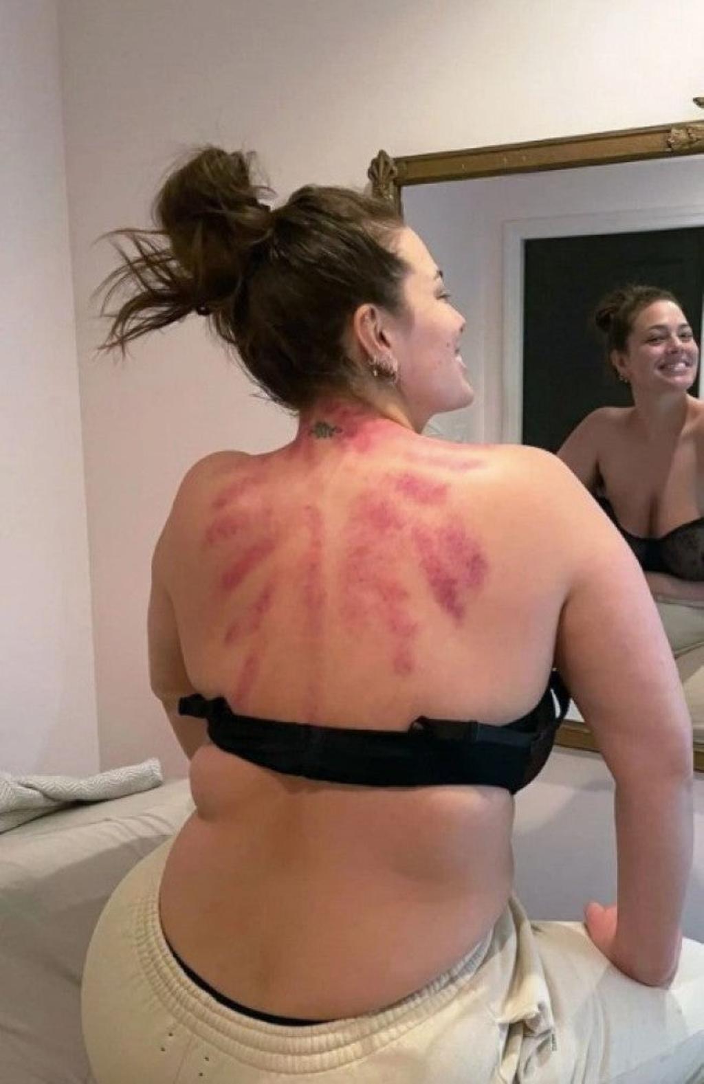 Ashley Graham enseña su espalda llena de moratones
