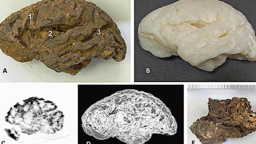 El estudio de los cerebros desenterrados en la fosa común de La Pedraja, en Burgos.