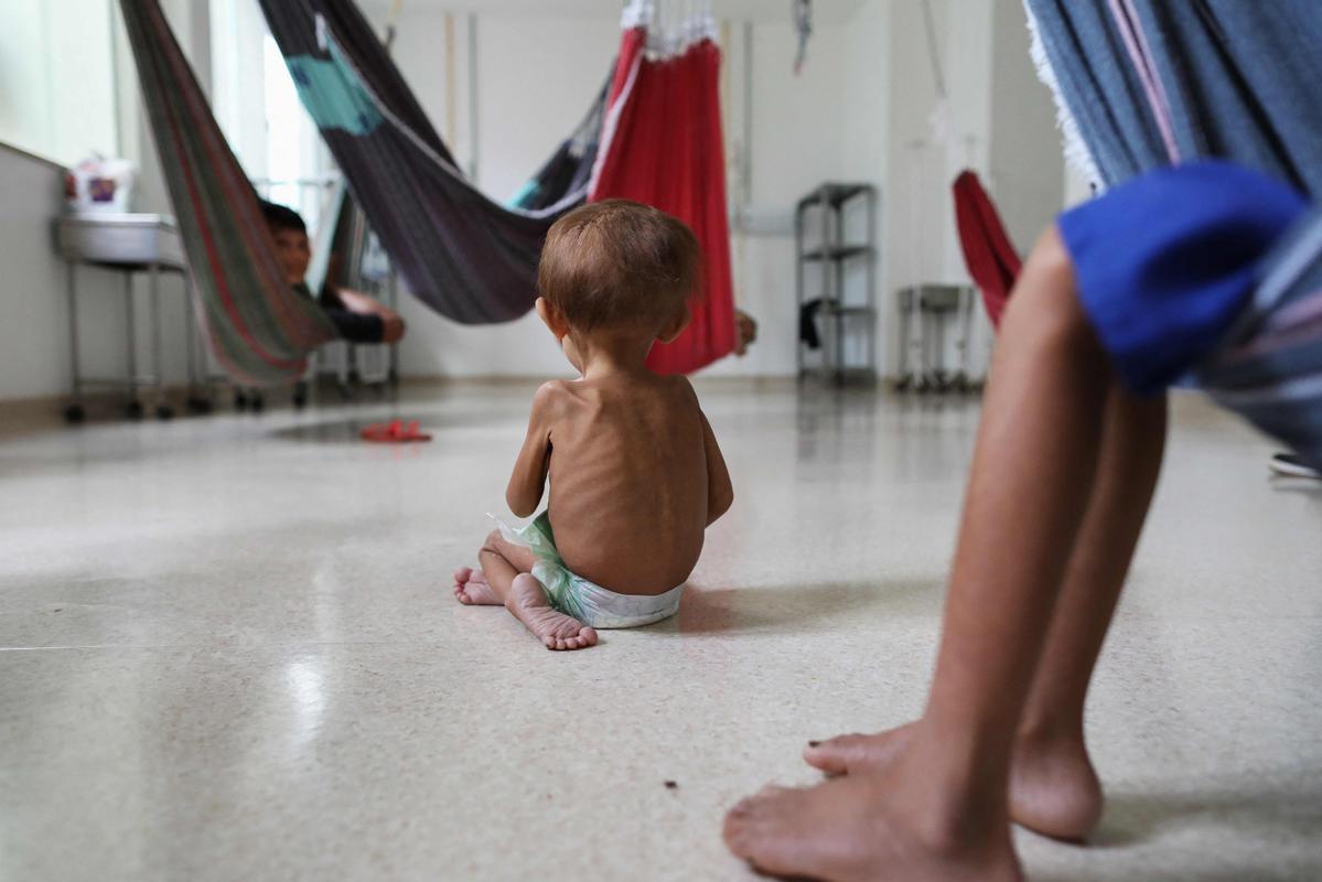 Niño indígenas yanomami desnutridos reciben tratamiento en el Hospital Infantil Santo Antonio en Boa Vista, estado de Roraima, Brasil.