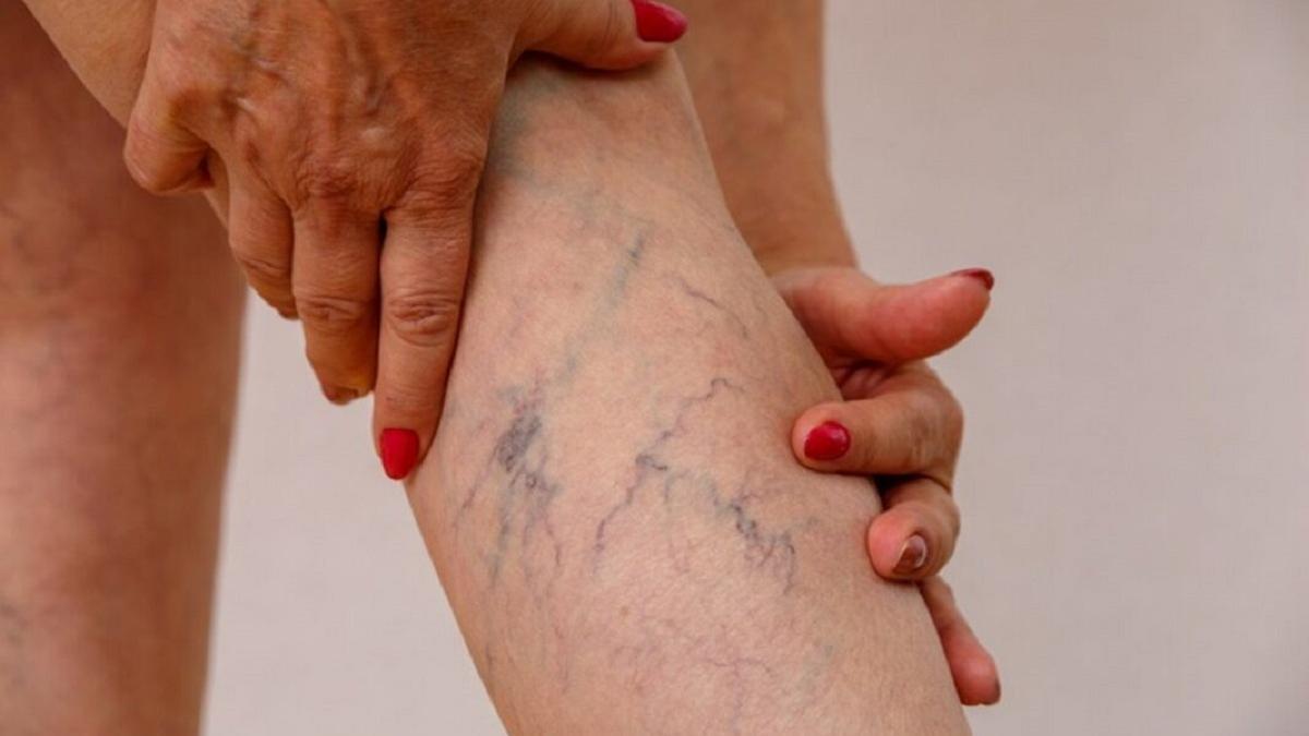 Últimos métodos para solucionar las varices: ¿por qué aparecen?