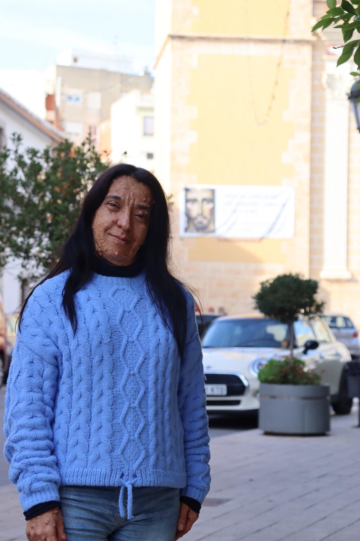 Marga convive con neurofibromatosis tipo 1 y reclama mejor atención médica.