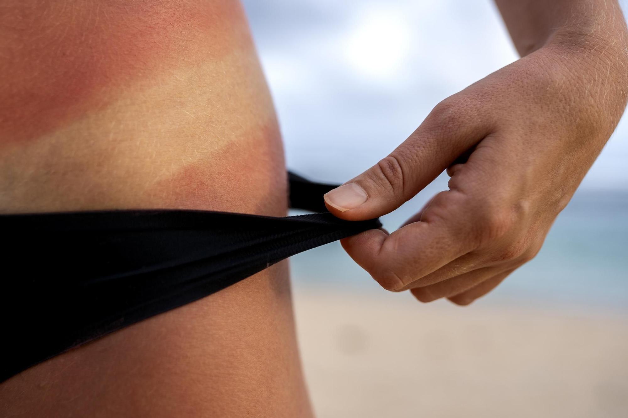 Cinco consejos para proteger tu piel del sol Levante EMV