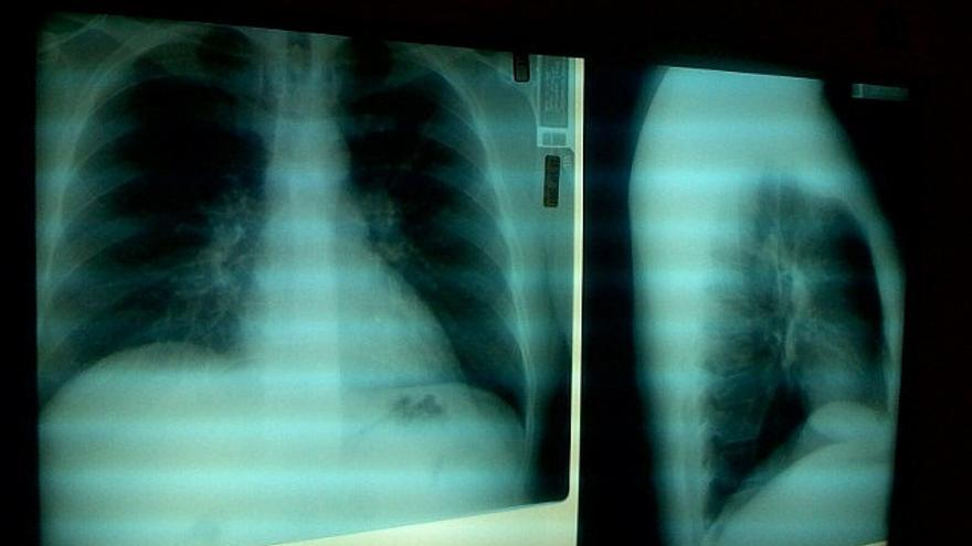 Radiografías de los pulmones de un paciente.