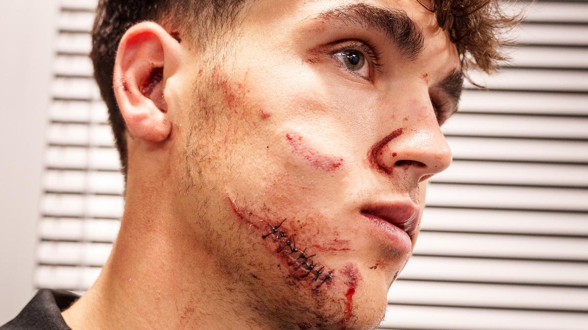 Les points de suture dont Pau Cubarsí avait besoin au visage après le coup qu'il a reçu lors du match Étoile Rouge-Barça à Belgrade.