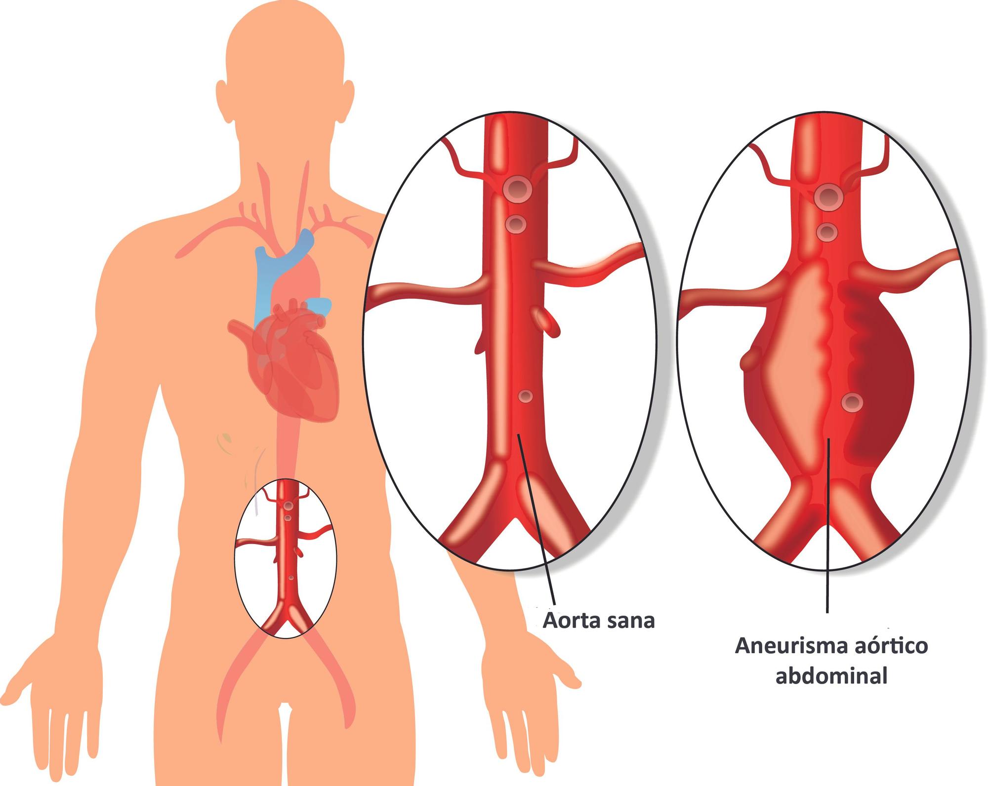 Reproducción de la aorta sana y el aneurisma aórtico abdominal.