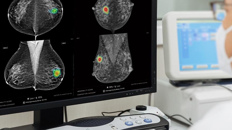 La plataforma de IA permite localizar un tumor de mama con una fiabilidad del 96%.
