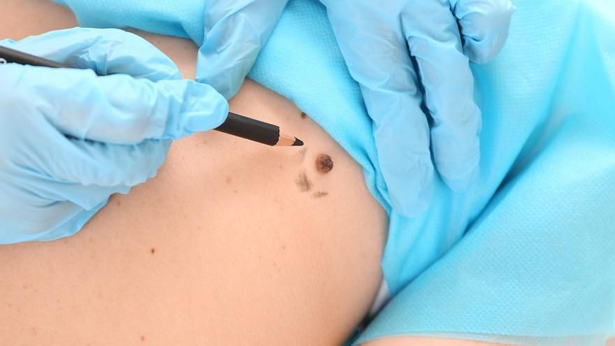 Claves para identificar y prevenir el cáncer de piel más agresivo