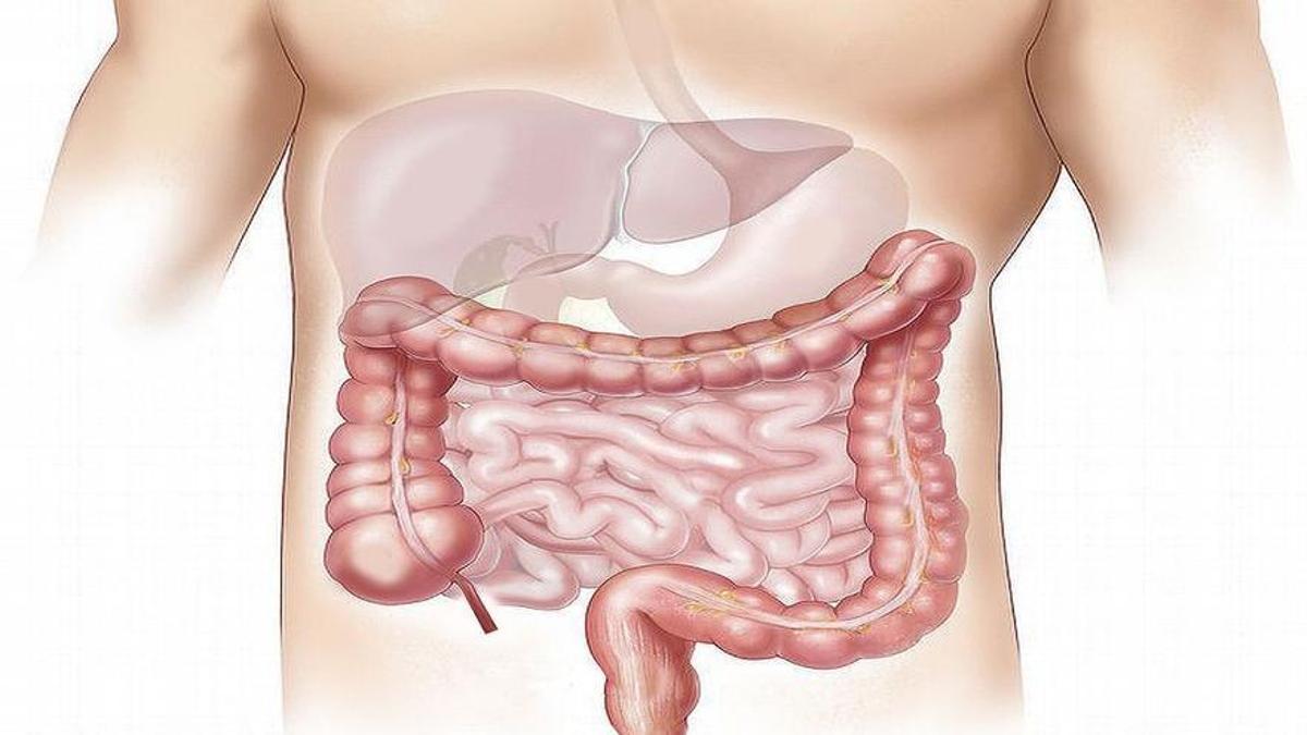 Cáncer de colon, la enfermedad silenciosa.