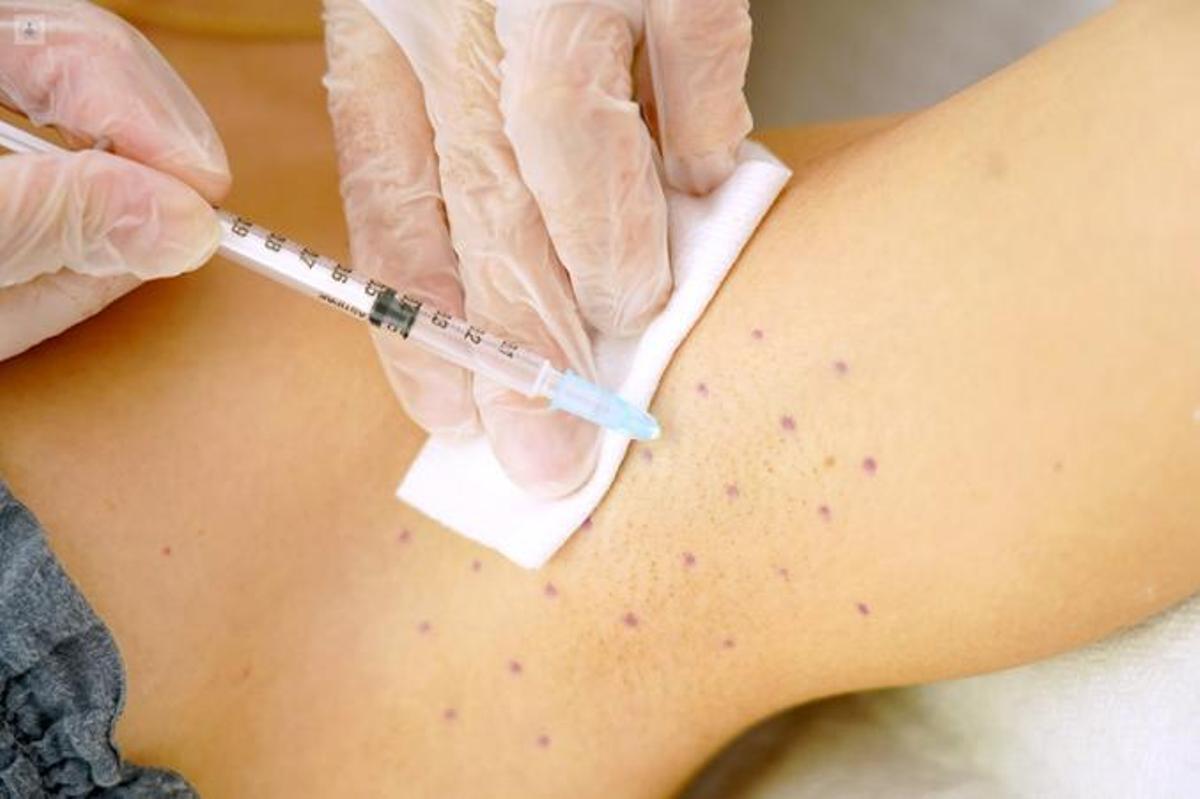 Tratamiento con microinyecciones de toxina botulímica