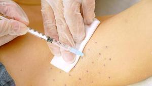 Tratamiento con microinyecciones de toxina botulímica