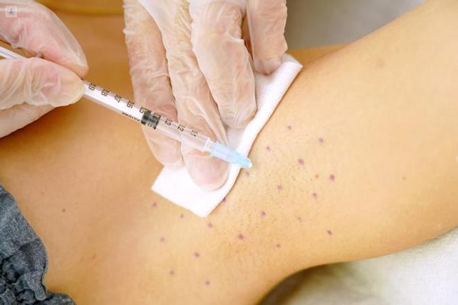 Tratamiento con microinyecciones de toxina botulímica