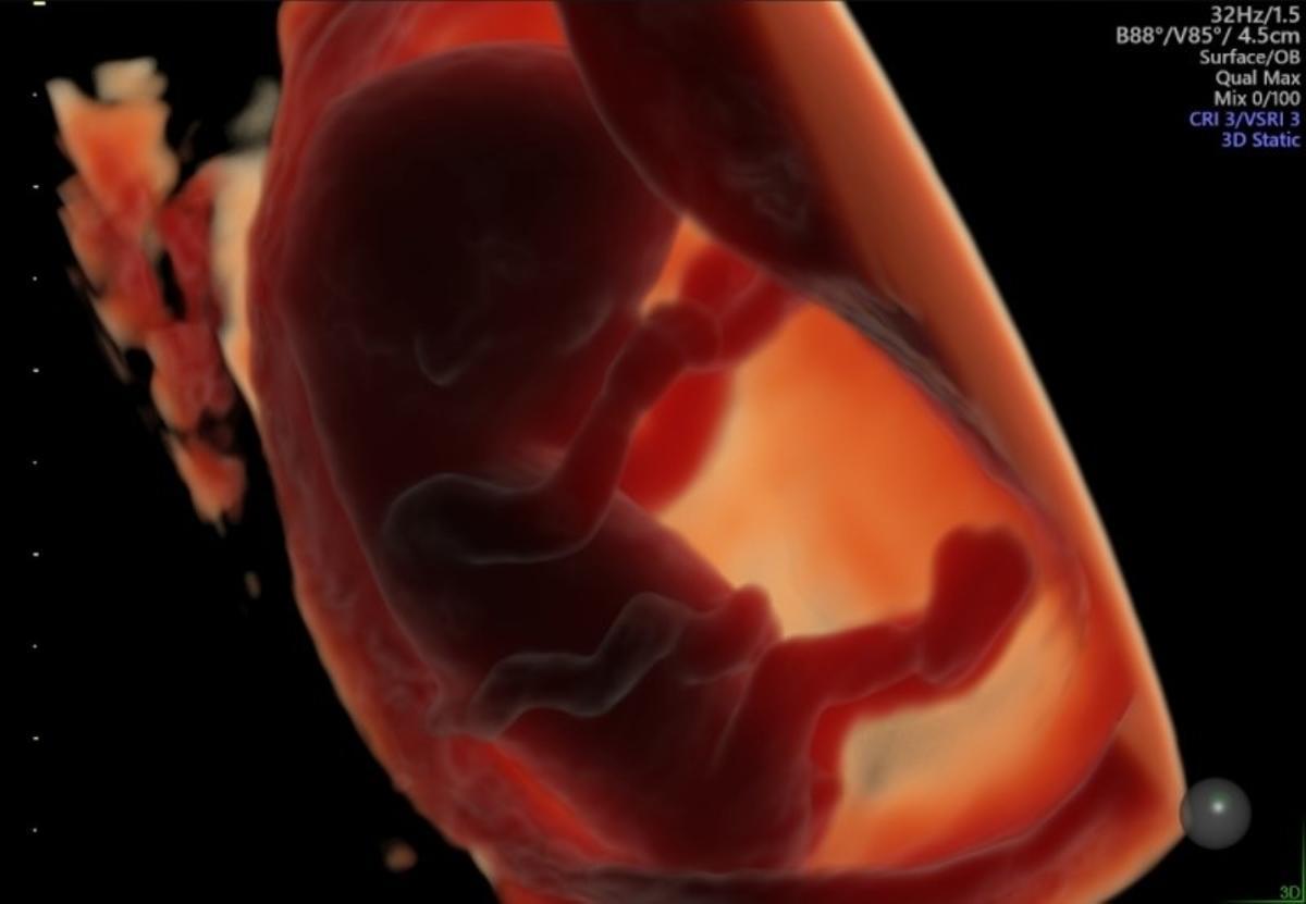 Un embrión de aproximadamente 11 semanas de gestación, obtenido mediante ecografía transvaginal 3D.