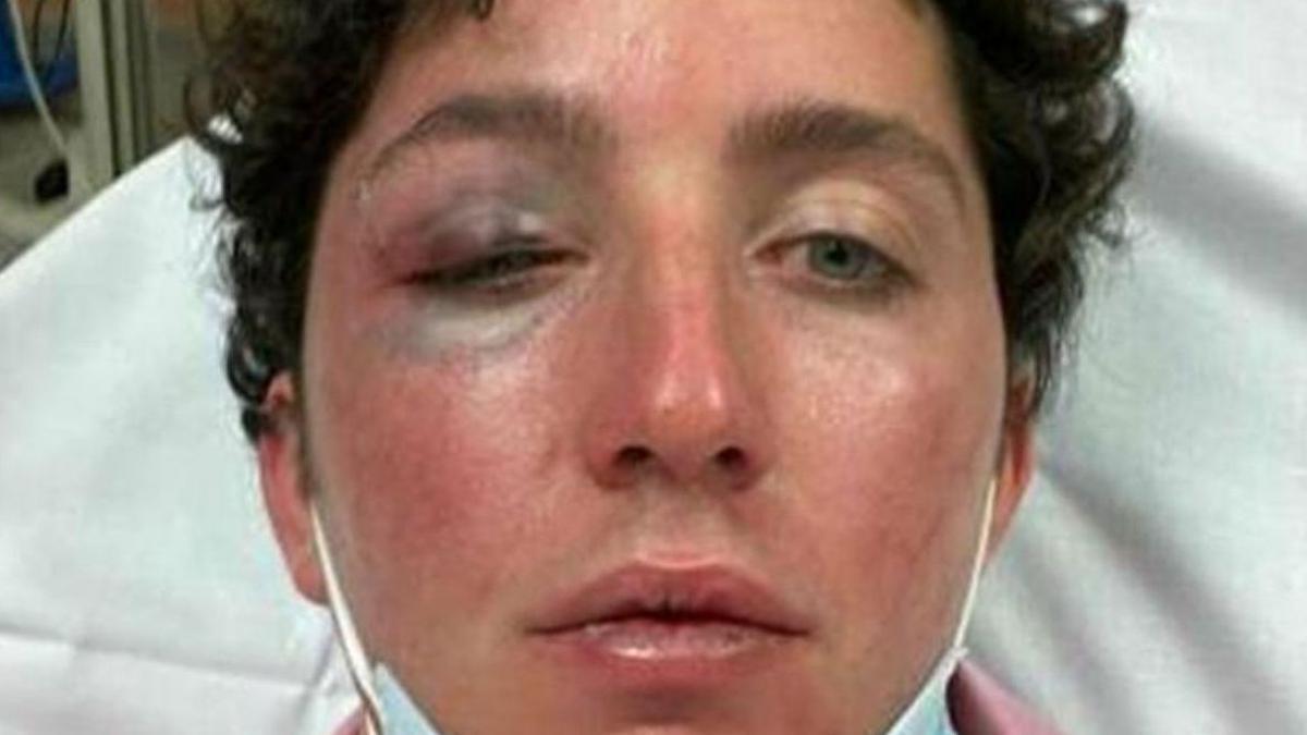 El 'Pequeño Nicolás', con las heridas en su rostro. EL CONFIDENCIAL