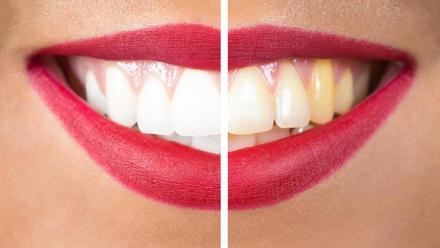 TRUCOS CASEROS PARA BLANQUEAR LOS DIENTES: Los trucos más eficaces para  blanquear tus dientes