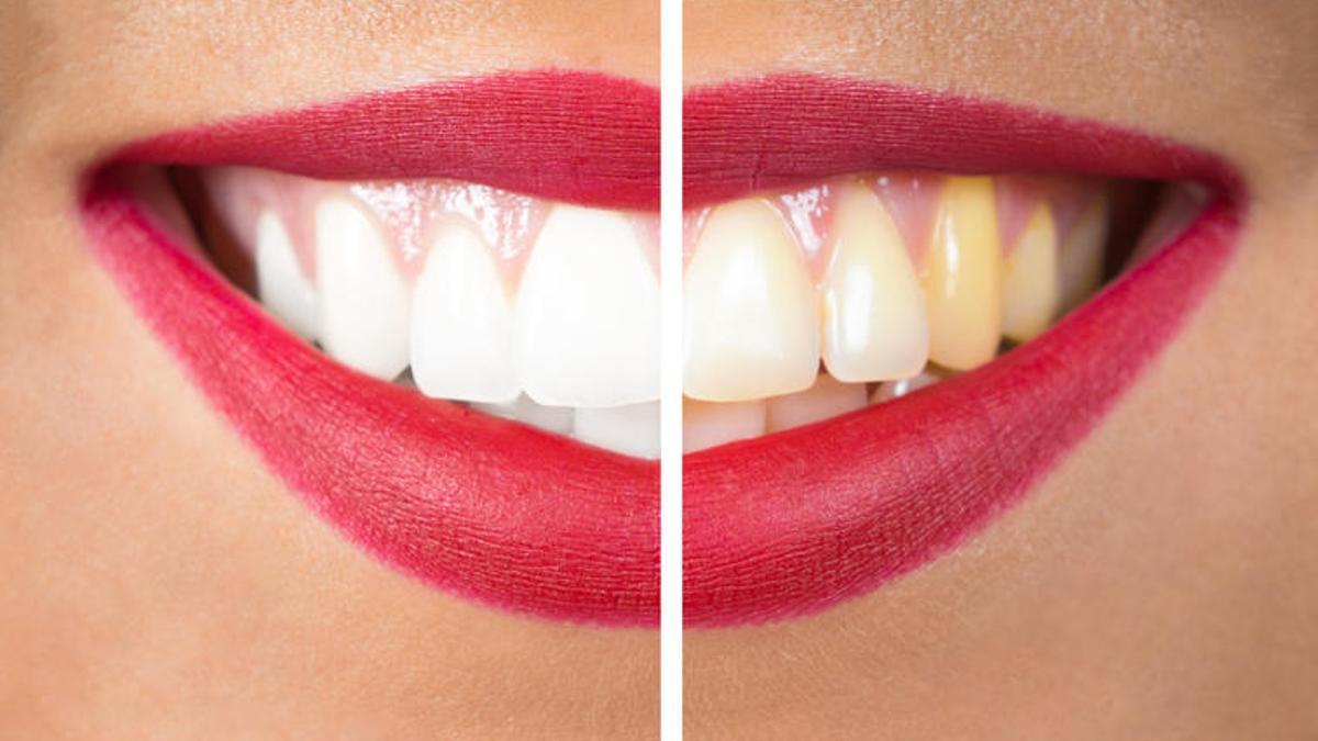 ¿Por qué se ponen los dientes amarillos?