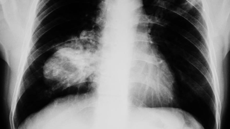 En el trabajo han participado investigadores de la US y de los hospitales Macarena y Virgen del Rocío de Sevilla.