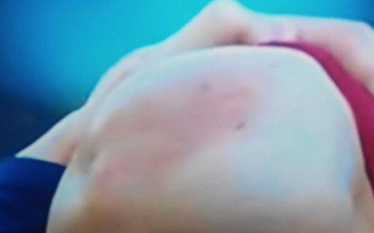 Así le quedó la rodilla a Messi