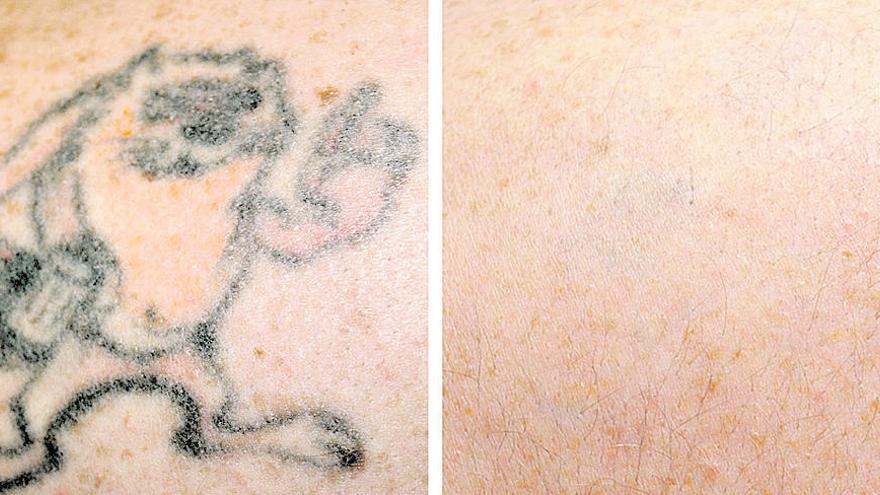 Antes y después de un tatuaje tras tres sesiones con Picosure