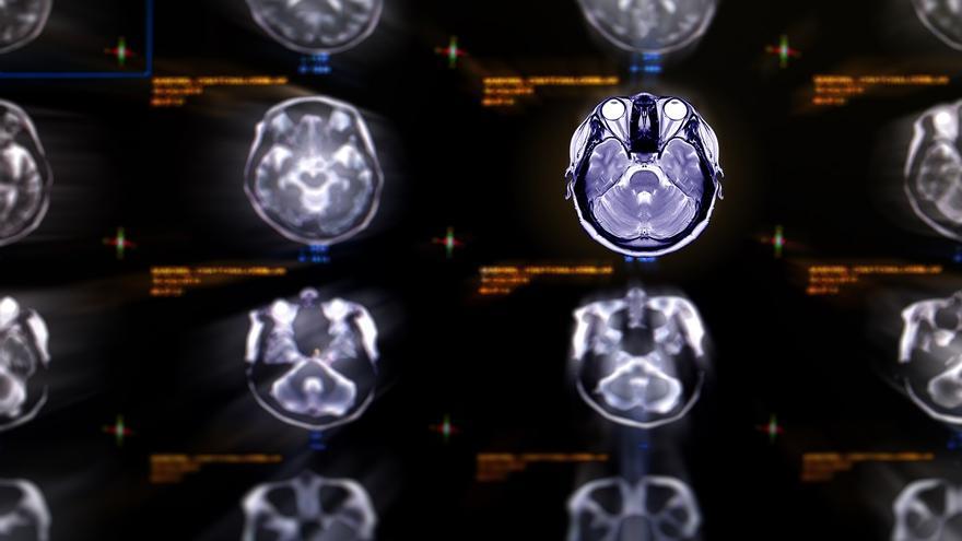 ¿Afectan al cerebro y provocan demencia las enfermedades cardiovasculares?