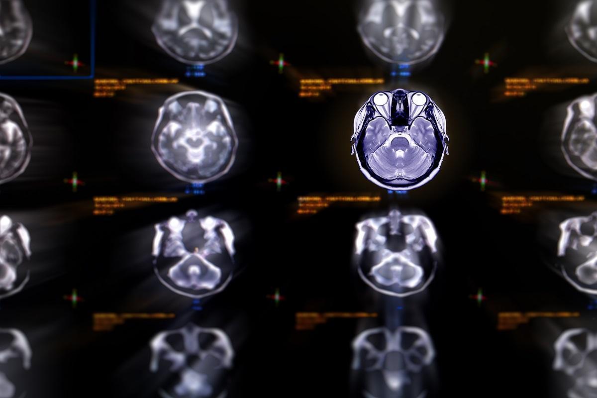 Hipertensión, diabetes, colesterol, sedentarismo…. ¿Podrían afectar al cerebro además de a tu corazón?