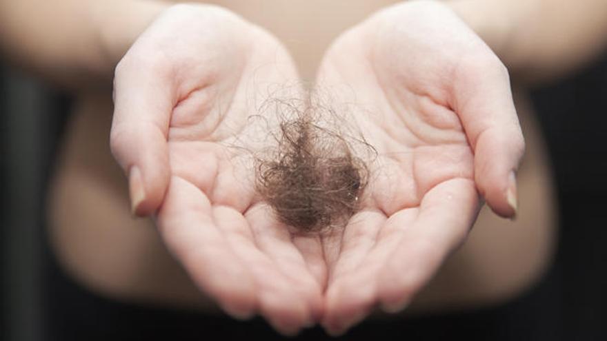 ¿Qué sabemos de la alopecia universal?
