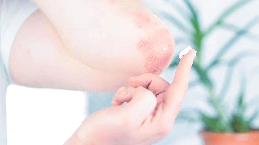 Investigadores de la UMU se alían con el pez cebra para tratar la psoriasis