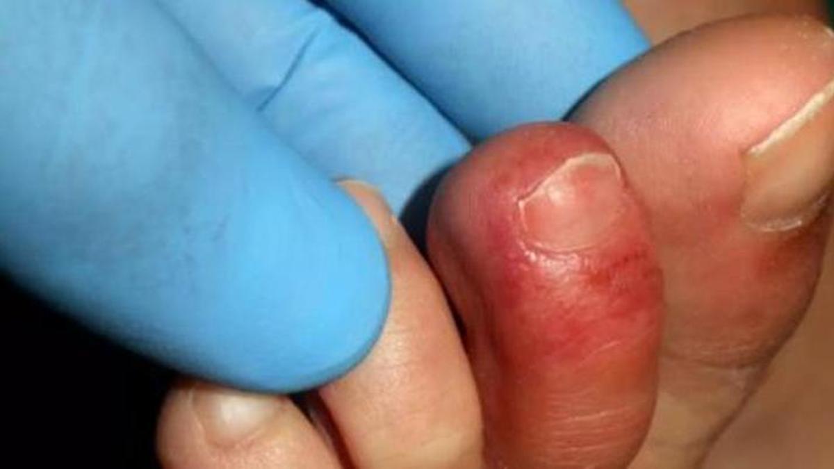 La dactilitis, o dits en salsitxa, és un símptoma de malalties reumatològiques