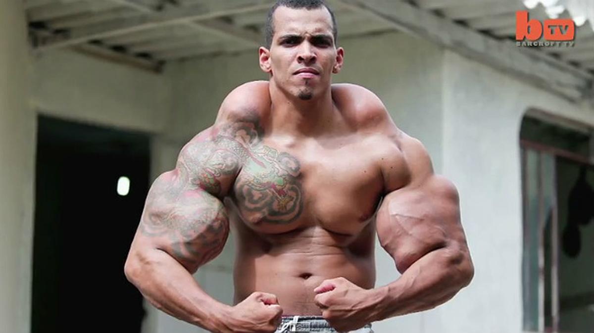 Romario Dos Santos puso en riesgo su vida al inyectarse durante años Synthol y alcohol en sus bíceps.