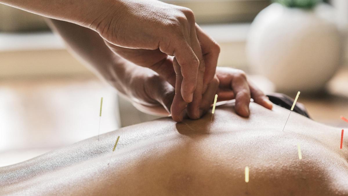 Agujas de acupuntura.