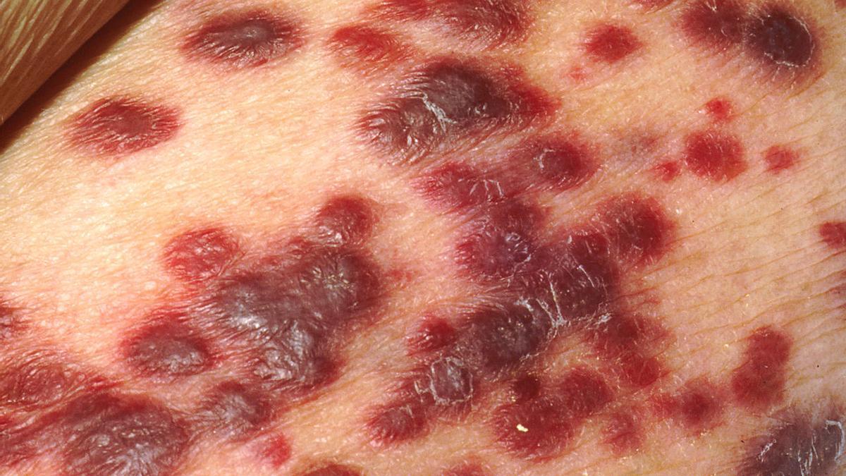 Sarcoma de Kaposi en la piel de una paciente con SIDA.