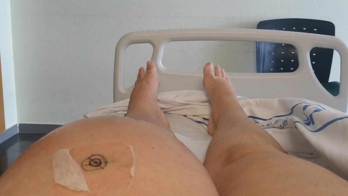 Estado de la pierna de la paciente cuando estaba ingresada en el Hospital Universitario Insular de Gran Canaria.