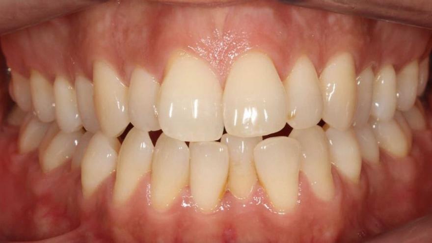 L’abans i el després d’un apinyament dental tractat a la clínica Cistina Talló.