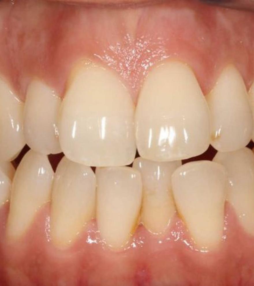 Apinyament dental, un dels maldecaps més habituals de les malposicions dentals