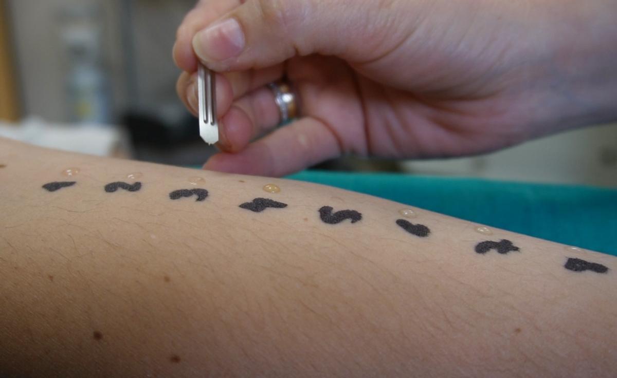 Imagen de un test cutáneo de alergias.